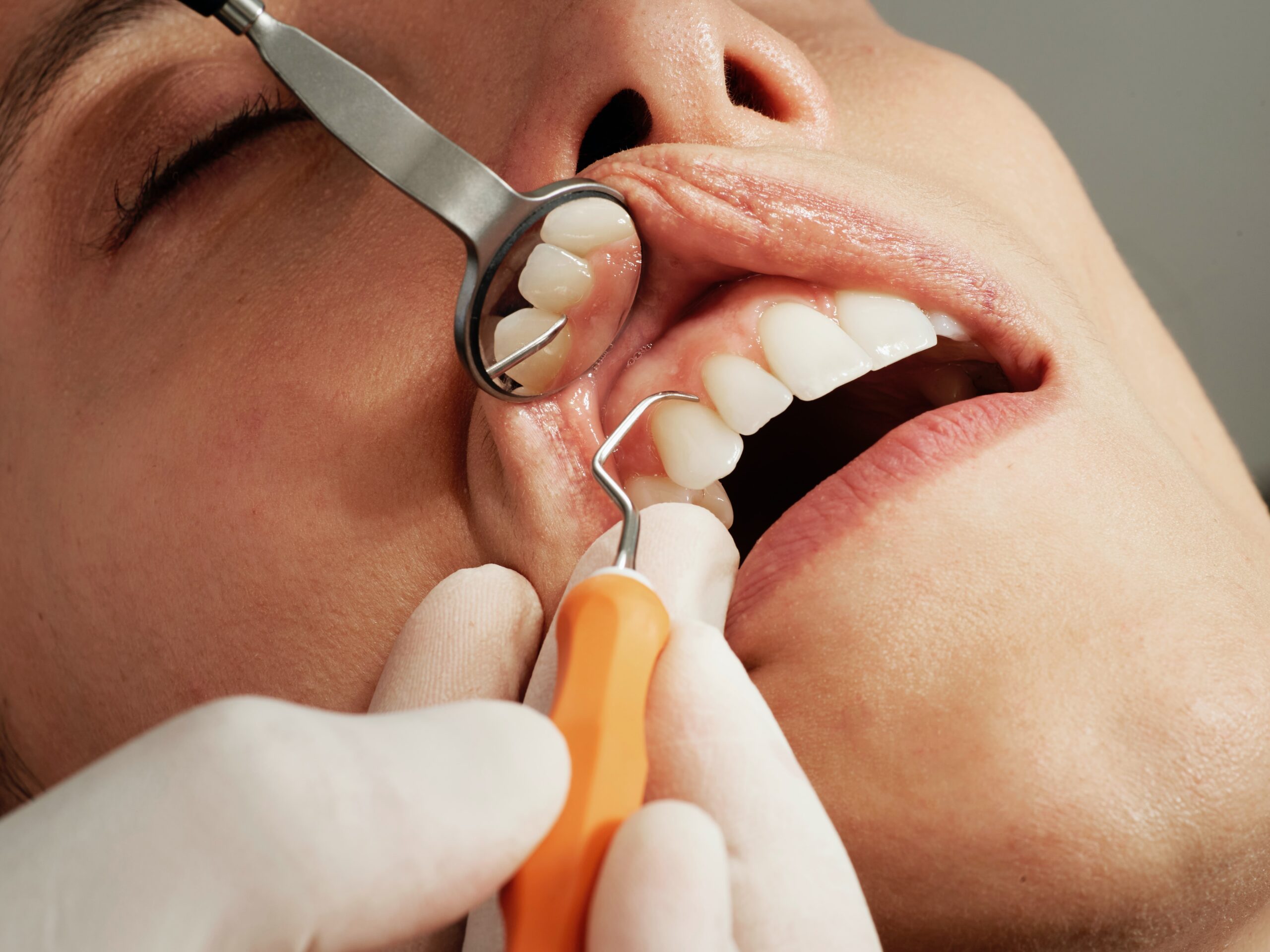Why Trust Your Smile to Dental Veneers?